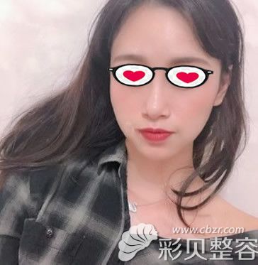 脂肪填充太阳穴67天的效果