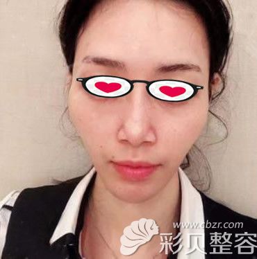 自体脂肪填充太阳穴前