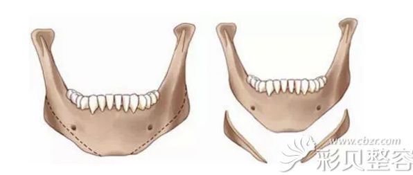 下颌骨整形需要削骨磨骨