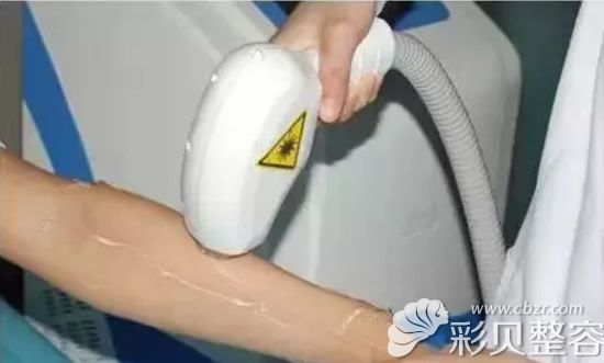 冰点脱毛操作中