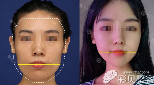面部轮廓整形效果图