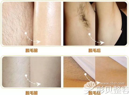 脱毛前后对比图