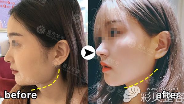 削下颌骨三年前后对比照片