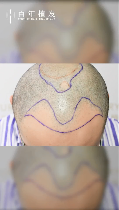 头发种植，选择一次，改变一生