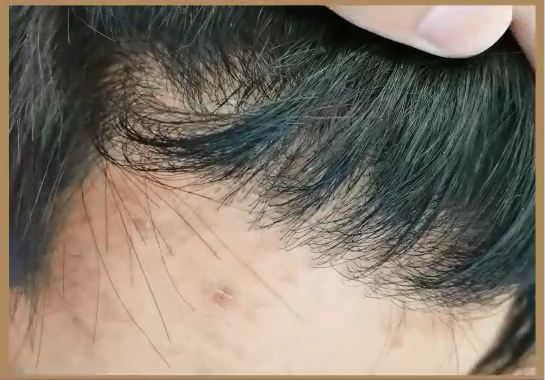 发际线种植术后1年种植效果