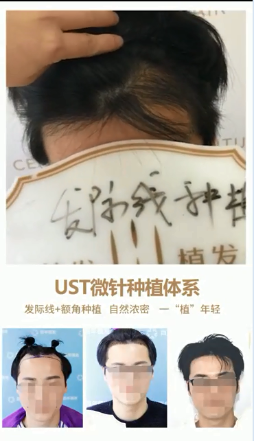 发际线种植术后两个月恢复效果