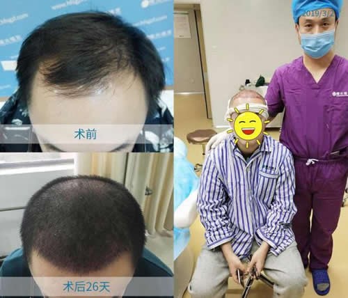 植发真实案例照片证实:很多人植发两三年基本脱落了不可信