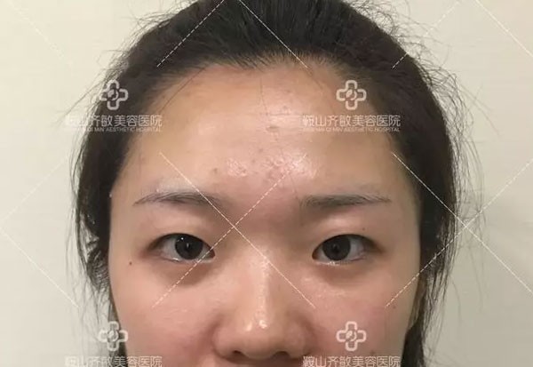 快来听听我割双眼皮不变丑、不后悔的原因及恢复过程吧！