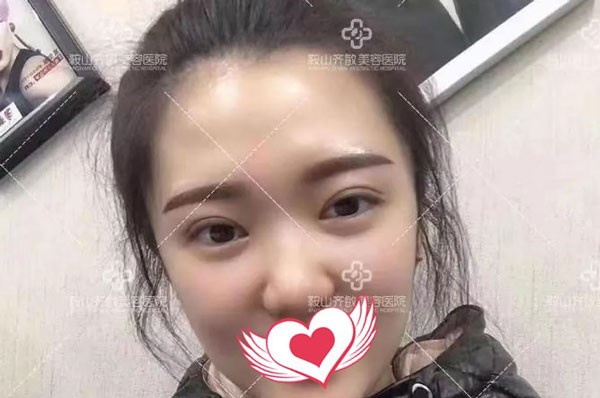 快来听听我割双眼皮不变丑、不后悔的原因及恢复过程吧！