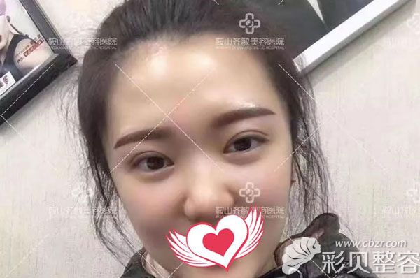 割双眼皮一个月的恢复效果图