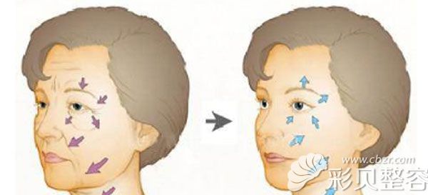 新式小切口除皱