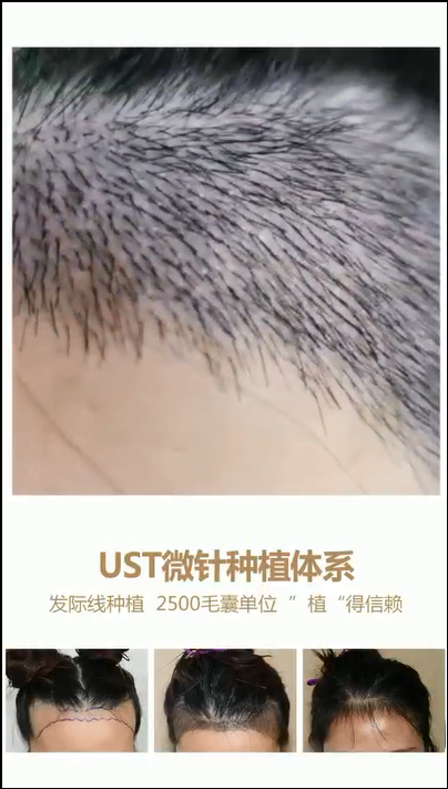 植出完美发际线，做回自信小仙女
