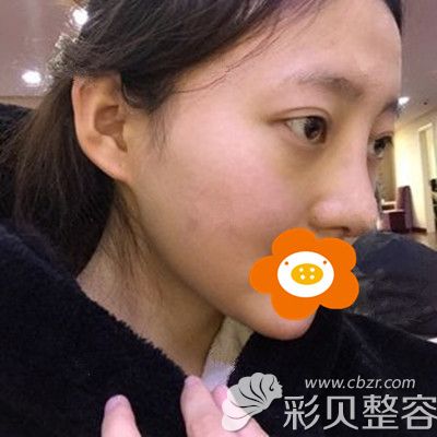 综合隆鼻术后7天拆线 综合隆鼻术后7天拆线