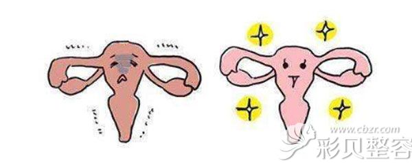 阴道紧缩术 阴道紧缩术