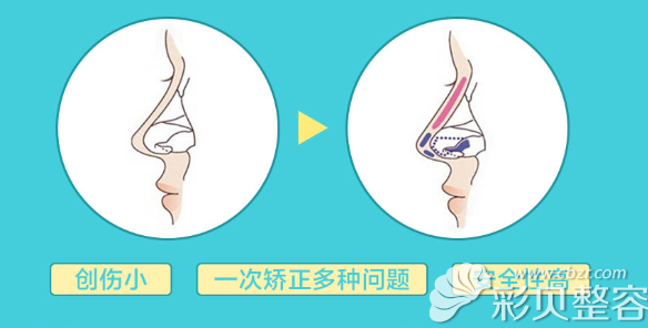 济南鹏爱邹星亚隆鼻技术特点