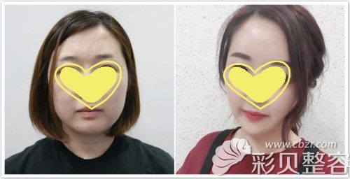 下颌缘黄金微雕做完40天下颌有硬块好丑是啥原因能否消除