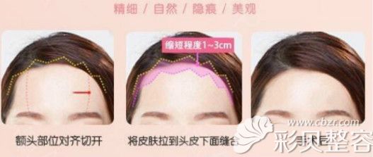 额头缩小术过程图解