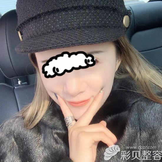 膨体半肋骨第7天拆线后效果