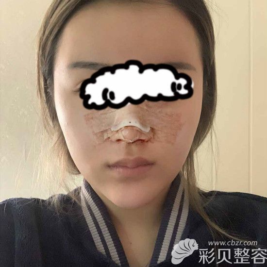 膨体半肋鼻术后第三天