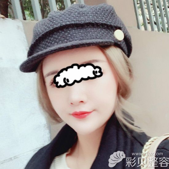 做完膨体半肋鼻一年后效果鼻子没有变矮很多