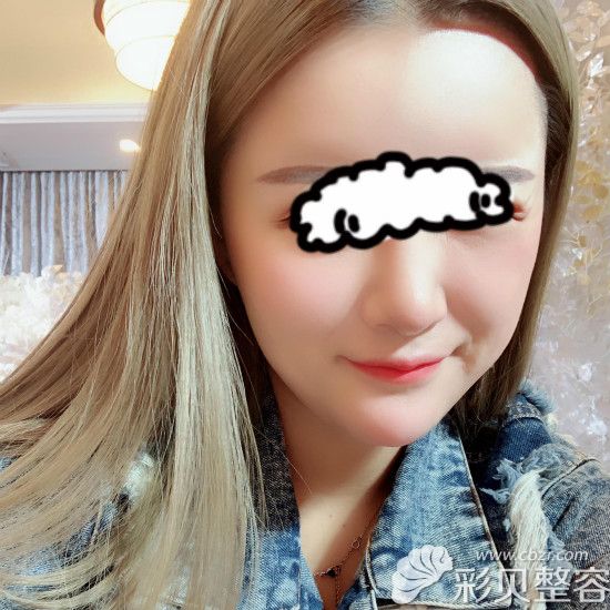 做完膨体半肋鼻三个月照片效果