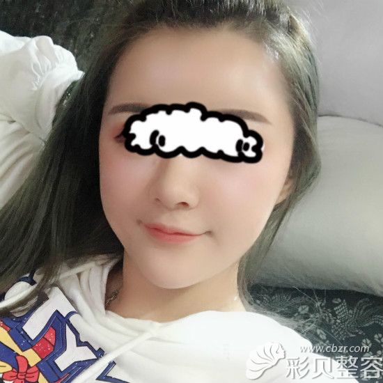 半肋膨体隆鼻术后一个月效果