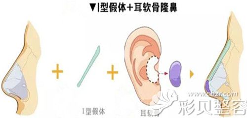 I型假体+耳软骨隆鼻 I型假体+耳软骨隆鼻
