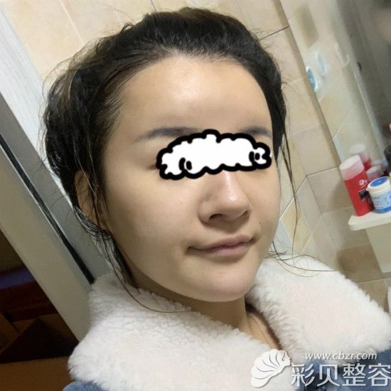 隆鼻术前样子