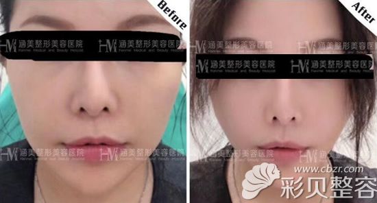 面部做埋线提升先后对比图