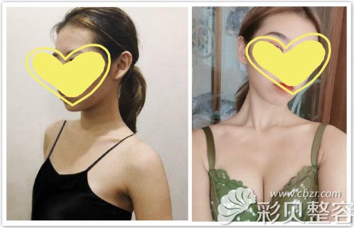 真人案例：棉花糖丰胸效果前后对比