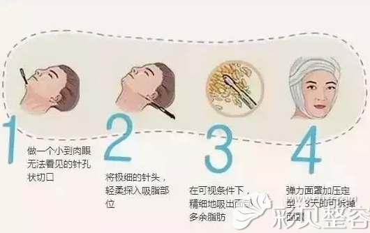 普通面部吸脂手术过程图解