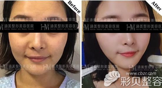 脸上做埋线提升一个月后的效果