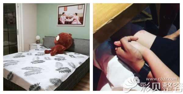 阴唇缩小手术已经一个月，私处紧致又小巧