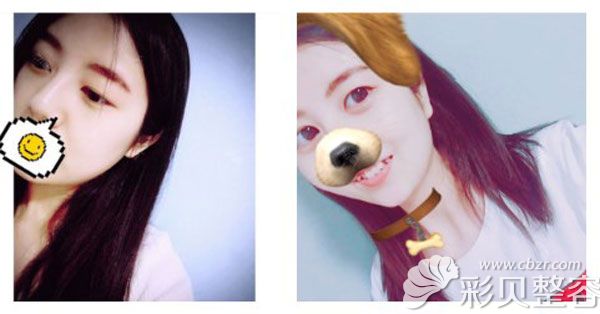 做阴唇缩小手术前