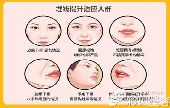 埋线提升适应人群