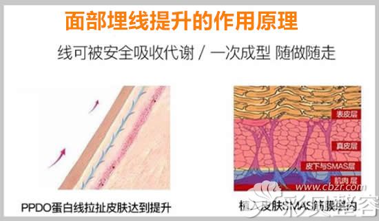 面部埋线提升的作用原理