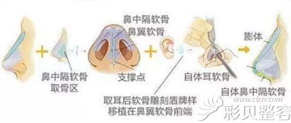 刘金霞医生做鼻综合手术的技术优势