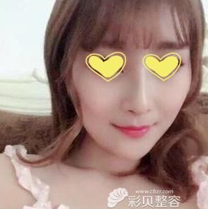 膨体加耳软骨隆鼻六年效果照片