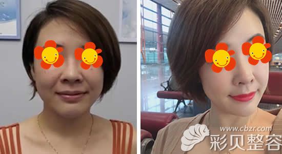 体验3次热拉提面部抗衰前后对比效果