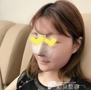 做完膨体加耳软骨鼻综合术后即刻效果