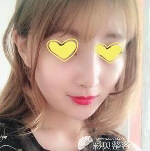 做膨体耳软骨隆鼻三个月恢复效果