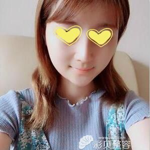 鼻综合术后15天效果