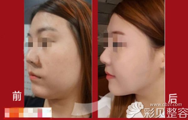 双下巴抽脂和去颊脂垫真人恢复图