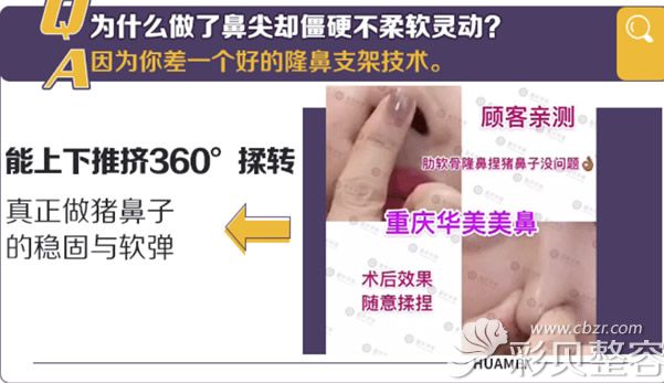 重庆华美耳软骨隆鼻恢复后可随意揉捏