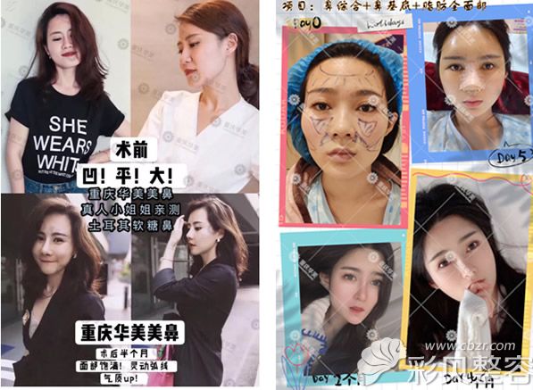 重庆华美张国强综合隆鼻+面部脂肪填充案例