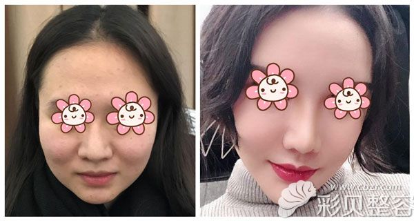 下颌角截骨+苹果肌提升效果对比图