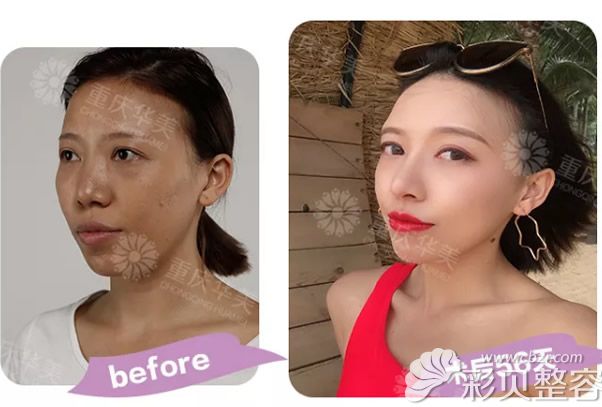 华美真人膨体隆鼻+自体软骨垫鼻尖前后对比照片