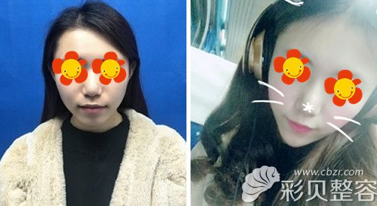 韩国贝拉玻尿酸打下巴怎么样