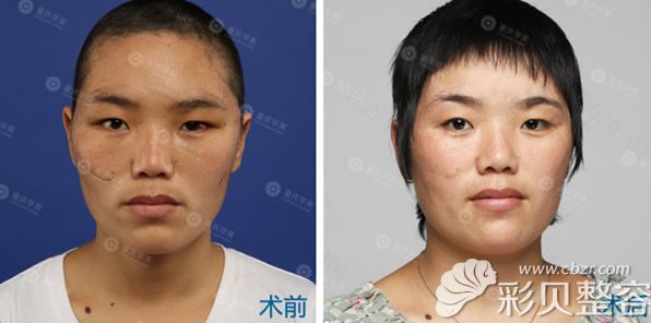 重庆华美医院面部缝针疤痕消除效果