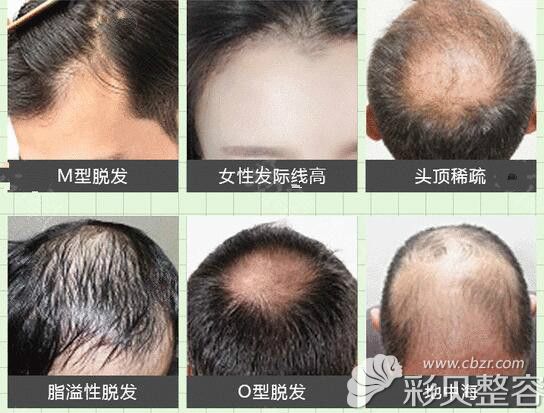 头发缺失问题